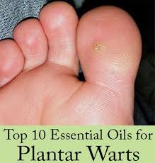 If you don't see any black dots, the plantar wart may be gone. Find Out The Best Essential Oils To Use For Plantar Warts And Recipes That Work Essential Oils For Plantar Warts Plantar Wart Types Of Warts