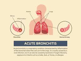 Image result for Acute Bronchitis