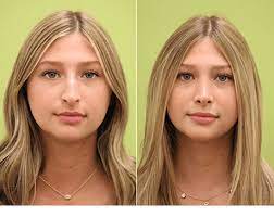 This is something he has the ultimate specialty for. Rhinoplasty Before After Mandeville La Slidell La Slent