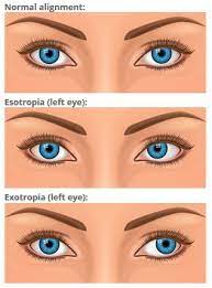 See full list on aoa.org Strabismus Crossed Eyes All About Vision