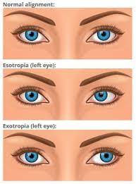 I don't know what to say if you have two lazy eyes. Strabismus And Crossed Eyes Explained Allaboutvision Com