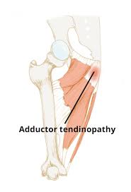 It connects from the top of your pelvic bone to just below your knee. Adductor Tendinopathy Circle Health