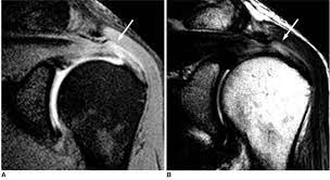 47 Year Old Man With Bursal Sided Partial Thickness Tear A Download Scientific Diagram