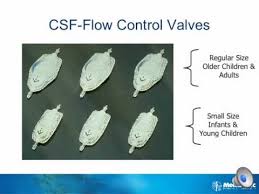 Medtronic Hydrocephalus Shunt Surgery Youtube