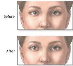 Fix Lazy Eye Washington Dc - Correct Lazy Eye Glenn Dale, Md | Envision Eye  And Laser