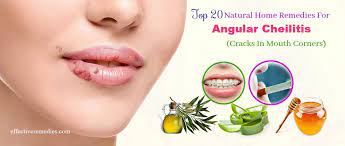 Best Home Remedies For Angular Cheilitis Cracks In Mouth Corners Cracked Corners Of Mouth Home Remedies Remedies