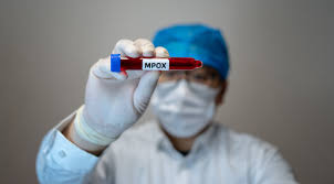 Mpox: quali sono i sintomi, cosa rischia chi viene contagiato, perché i casi sono in aumento. E perché non va chiamato «vaiolo delle scimmie» - Open