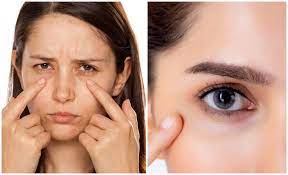 10 cara ini diharapkan bisa jadi solusi agar mata kembali sehat dan cantik. Ini Antara Petua Hilangkan Eyebag Dengan Cepat Mudah Berkesan Buzzkini