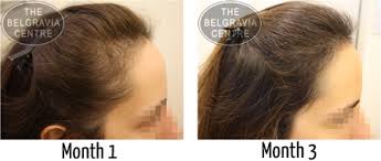 Androgenetic alopecia in women usually starts and progresses with a widening of the central part and evident hair thinning on the top of the head. What Is Diffuse Hair Loss