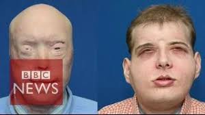 The 'world's most extensive' transplant