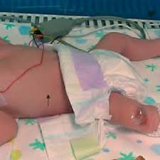 Therefore, in the case of chickenpox, the feature of the second peak might characterize the epidemic pattern of each prefecture. Pdf Congenital Varicella Syndrome Still A Problem