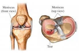 If you have a partial or total meniscectomy, you can expect your recovery to take about a month. Meniscus Tear Different Treatment Options For Different Meniscus Tears Orthopedic Surgeon Dr Lawrence Li Md At The Orthopedic And Shoulder Center