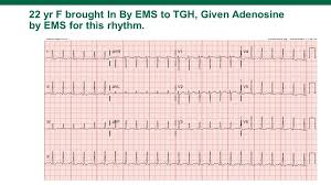 A normal heart rate is 60 to 100 beats per minute. Svt On The Ecg Usf Emergency Medicine Residency