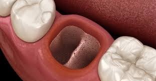 التهاب السنخ الجاف معلومات هامة ويب طب