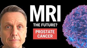 MRI Ultrasound Fusion for Prostate Biopsy Leonard Marks, MD