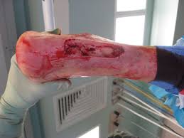 Most often, it causes mild infections on the skin, like sores, boils, or abscesses.but it can also cause more serious skin infections or. A Guide To Current And Emerging Antibiotics For Mrsa