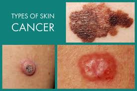 Understanding liver cancer is important if you want to develop an effective treatment plan and live a long and healthy life. Skin Cancer Dermatology Clinic Of North Mississippi