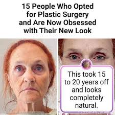 17 people who decided to undergo plastic surgery and never looked back: