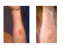 Image result for Rhus Dermatitis
