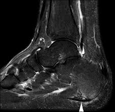 Lesions may be symptomatic because of a mass effect or invasion of adjacent muscles or neurovascular structures. Plantar Fasciitis On Mri A Sagittal Stir Image Shows Fusiform Swelling Download Scientific Diagram