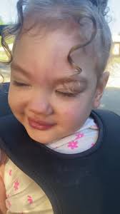 Understanding the Challenges of Parenting a Child with Schizencephaly