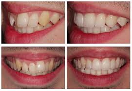 Kissdental is your trusted dentists in manchester that offers dental treatments including teeth implants, crowns, and cosmetic dentistry. Inman Aligner Liverpool The Remarkable 16 Week Removable Braces