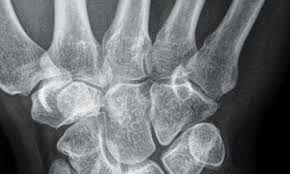 Hallo , ich bin mit meinem mtb gestürzt und habe jetzt eine undislozierte intraartikuläre radiuskopffraktur im ellenbogen links. Die Radiuskopfprothese Beim Trauma Mehr Als Nur Ein Platzhalter Atos News