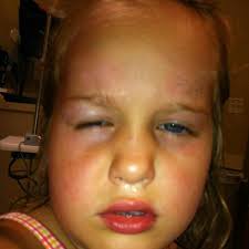 Koolaid Hair Dye Recipe Is Dangerous Red 40 And Vinegar Can Cause Chemical Burns On Some People Thi Kool Aid Hair Dye Koolaid Hair Dye Recipe Kool Aid Hair