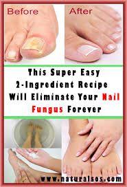 Get Rid Of Nail Fungus Forever With 2 Natural Ingredient Vita Mirabilis Nail Fungus Toe Fungus Remedies Fungus Treatment