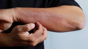 Image result for skin rash similar to scabies