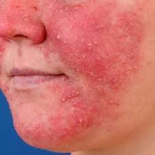 Image result for demodex rosacea