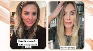 Botox Injections Gone Wrong Influencer Left With Drooping Eyelid Trending News The Indian Express