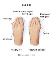Image result for Hallux Varus