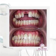 Jenis gigi palsu dental implan sendiri yaitu berupa penanaman logam dalam gusi kemudian diberikan mahkota tiruan menyerupai gigi asli. Pertimbangan Memilih Gigi Palsu Klinik Gigi Joy Dental