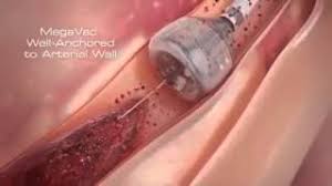 Cistoscopie cu montare stent ureteral. Stent Coronarian Pret Pareri Bucuresti