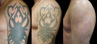 Tattoos can be a beautiful human expression but as our lives change, tattoo regret takes over. Tattoo Removal Methods Procedures Laser Tattoo Removal Revlite