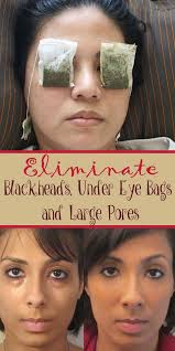 Laser skin rejuvenation, intense pulsed light (ipl) or chemical peels may also be options. Life Saving Hacks To Get Rid Of Dark Circles And Bags Under Your Eyes For Creative Juice