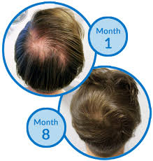 The hair extension can only. What Do You Recommend For A Thinning Crown