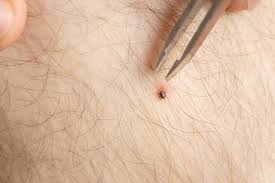 Image result for infected tick bite