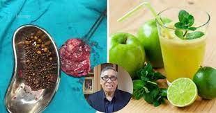 Dan untuk batu karang di buah pinggang dan saluran kencing. Dr Hamid Arshat Kongsi Petua Cara Rawat Batu Karang Dalam Hempedu Secara Semula Jadi Keluarga