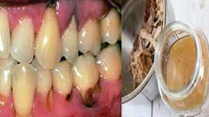 Egal Wie Viel Karies Mit Diesem Einfachen Hausmittel Kannst Du Es Behandeln Youtube