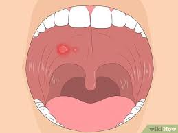 Some sores inside the mouth are usually raised and filled with fluid just like blisters. 3 Ways To Get Rid Of Mouth Blisters Wikihow