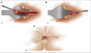 Image result for Hemorrhoid