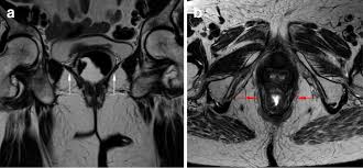 ƒ organs and structures of the female pelv. Dynamic Magnetic Resonance Imaging Of The Female Pelvic Floor A Pictorial Review Insights Into Imaging Full Text