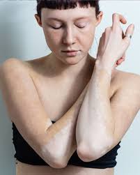 The Vitiligo