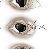 As the eyelid margin inverts, hair or eyelashes can rub on the cornea, causing pain and corneal ulceration. Https Encrypted Tbn0 Gstatic Com Images Q Tbn And9gcr6nit Oyl8sxjd2at48emgtrll9af 0sf97ri9oym5 Nzzy8qp Usqp Cau