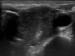 It does not mean cancer. Figure 4 Application Of Ultrasound Guided Core Needle Biopsy In The Diagnosis Of T3 Or T4 Stage Laryngeal And Hypopharyngeal Cancer Anticancer Research