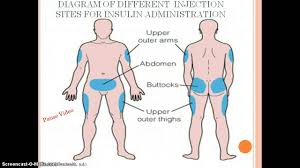 Check spelling or type a new query. Insulin Administration Youtube