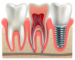 Dr Krauss Is The Best Dentist In The Bakersfield For Best Dental Care He Has Performed Thousands Dental Implants Tooth Implant Cost Affordable Dental Implants