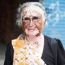 Greetings from Bahrain to all our vitiligo supporters around the world.